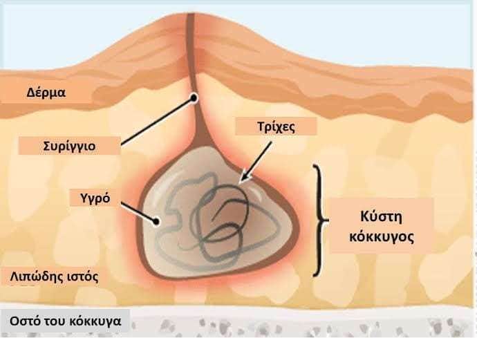 Κύστη κόκκυγος: όλα όσα πρέπει να γνωρίζετε