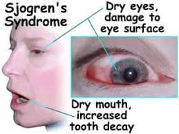 σύνδρομο sjogren