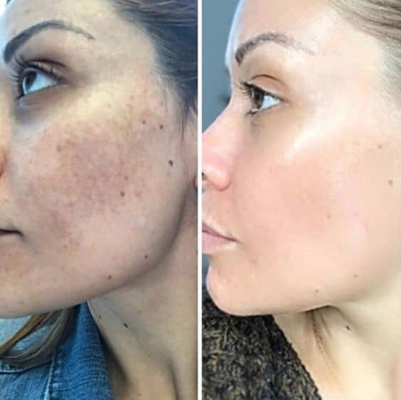 nanopeeling